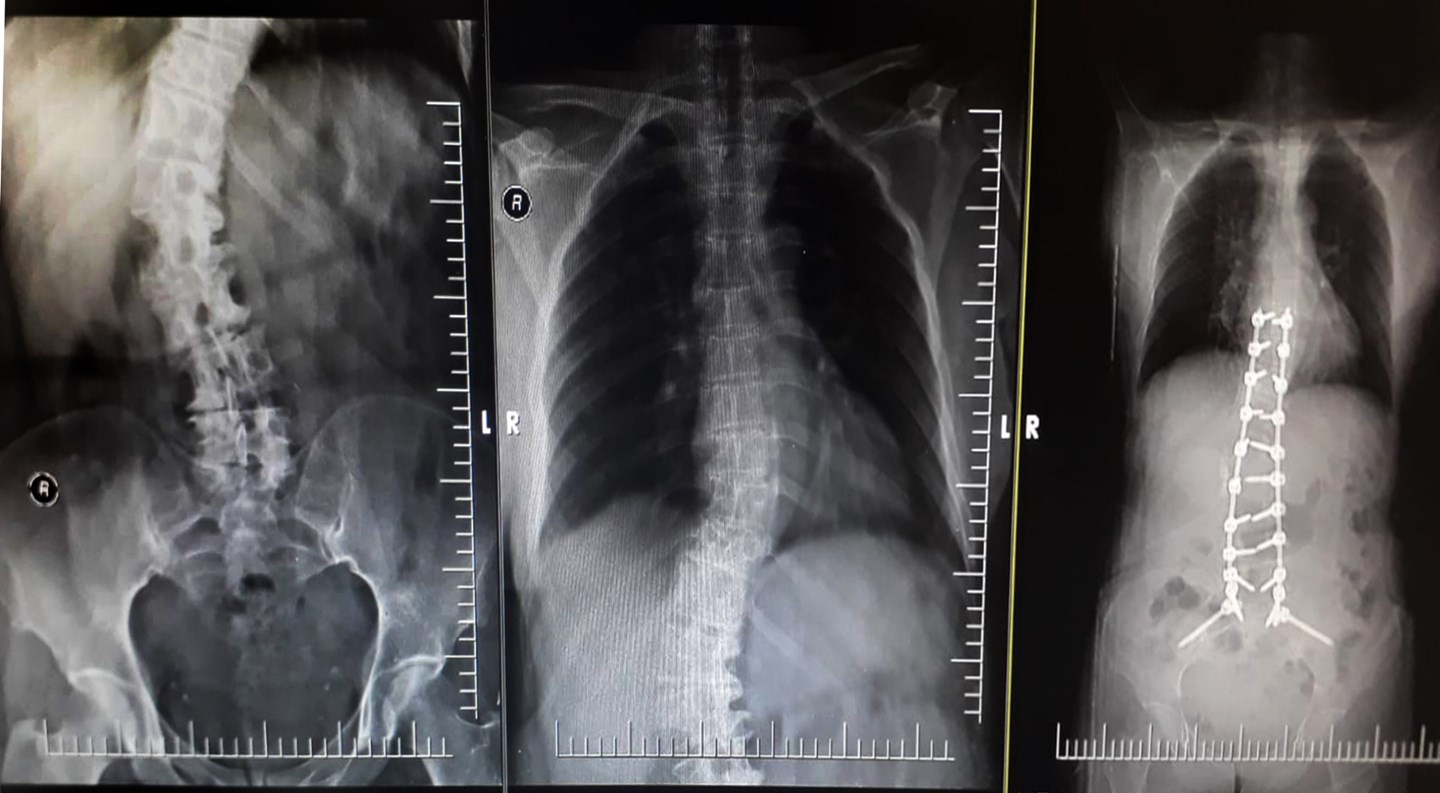 A PATIENT WITH SPINAL CORD DEFORMITY FOUND HEALING AT PARKHAYAT HOSPITAL